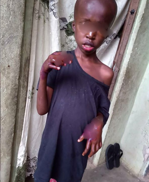 Mum burns son’s hands over stove (Graphic Pics)