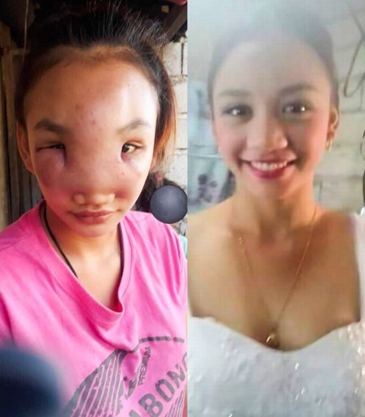 17-year-old girl goes blind after squeezing spot on her nose